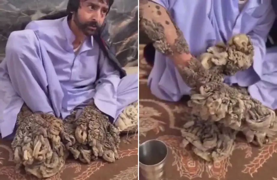 بیماری مرد درختی ایرانی