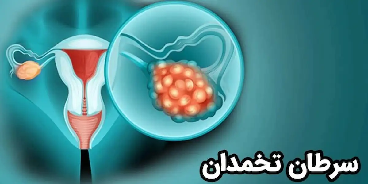 سرطان تخمدان