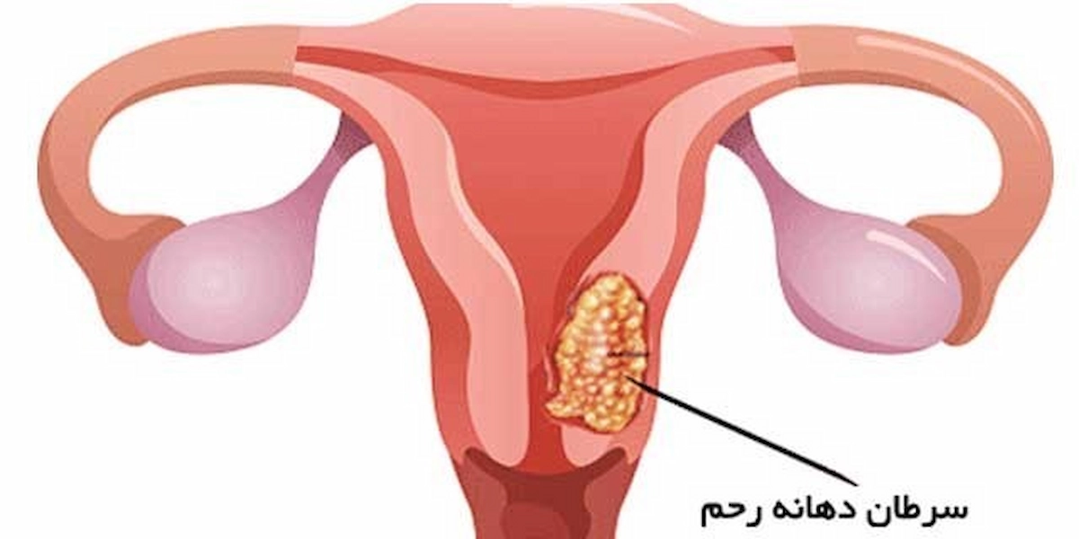 سرطان دهانه رحم