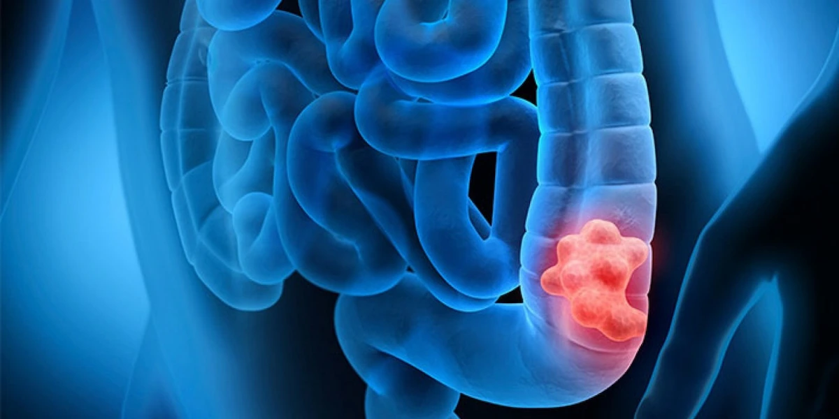 سرطان روده بزرگ-1