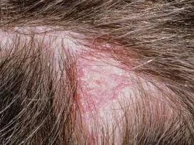 اگزما پوست سر کودکان:راهکار های پیشگیری و درمان