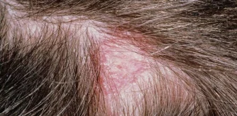 اگزما پوست سر کودکان:راهکار های پیشگیری و درمان