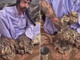 بیماری مرد درختی ایرانی