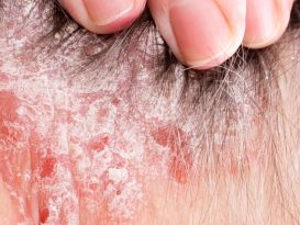 اگزما روی پوست سر