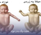 زردی نوزاد خطرناک است