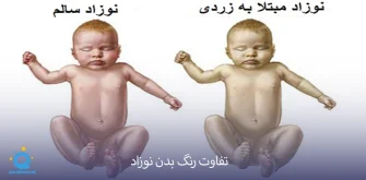زردی نوزاد خطرناک است