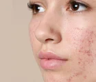 روتین پوستی پوست چرب : نکات کاربردی