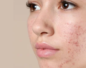روتین پوستی پوست چرب : نکات کاربردی